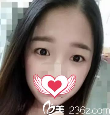 术前单眼皮 术前单眼皮