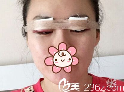 刚做完埋线法双眼皮 刚做完埋线法双眼皮