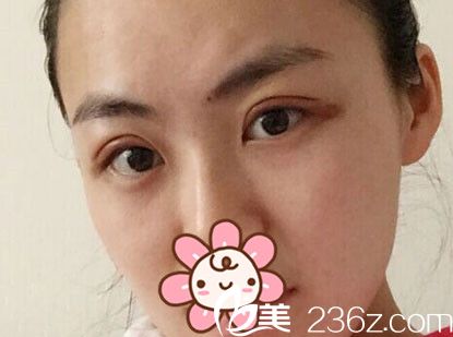 冰敷后双眼皮适当消肿 冰敷后双眼皮适当消肿