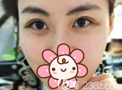 趁优惠在张家港唯恩做了埋线法双眼皮术后七天就基本恢复 闺蜜看了也准备割双眼皮
