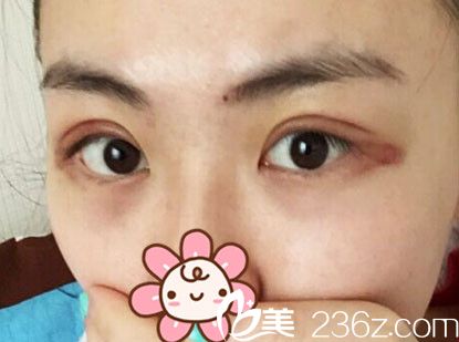 术后四天双眼皮手术恢复中 术后四天双眼皮手术恢复中