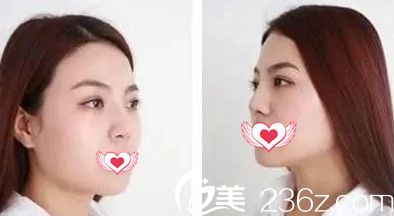 恢复22天鼻子高挺 恢复22天鼻子高挺