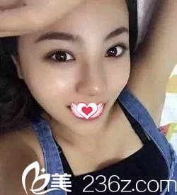 术后18天鼻子消肿 术后18天鼻子消肿