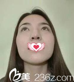 鼻综合7天拆线后的样子 鼻综合7天拆线后的样子