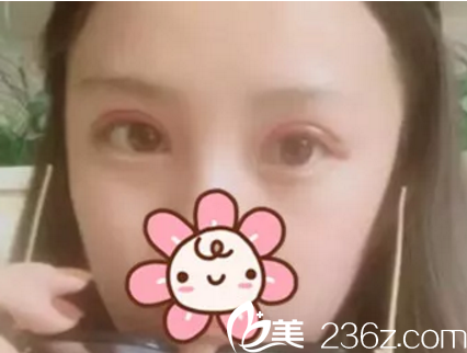 南宁美丽星做双眼皮术后15天