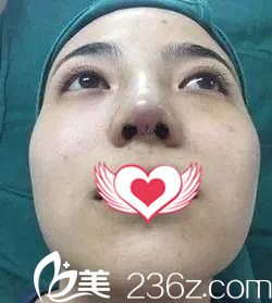 刚做完鼻综合整形的鼻子有点肿 刚做完鼻综合整形的鼻子有点肿