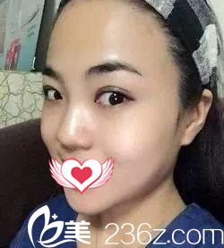 术前鼻子塌平 术前鼻子塌平