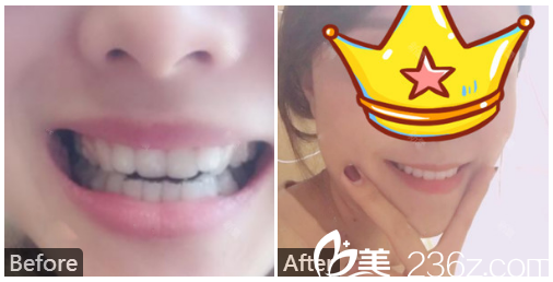 广州利美康牙科医院方起骏牙齿矫正案例对比图