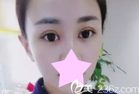 韩国紫馨整形美容医院全切双眼皮术后效果