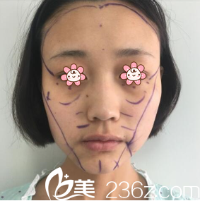 我去了韩国HG医疗整形美容外科面诊 我去了韩国HG医疗整形美容外科面诊