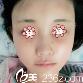 LEE CHONG RYANG院长给我做完手术后第四天 LEE CHONG RYANG院长给我做完手术后第四天