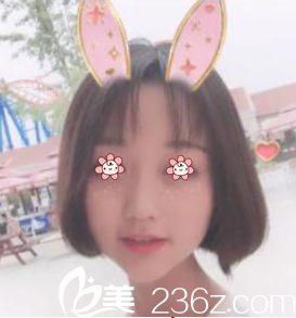 LEE CHONG RYANG自体脂肪面部填充术后半个月 LEE CHONG RYANG自体脂肪面部填充术后半个月