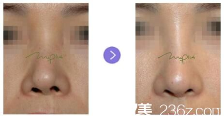 歪鼻、鼻尖整形前后对比 歪鼻、鼻尖整形前后对比