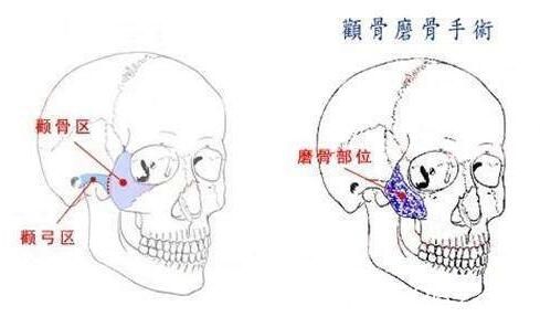 韩国江南stardom整形外科陈尚佑颧骨整形