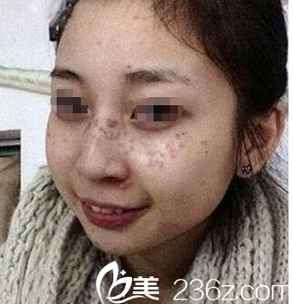 术前满脸雀斑样子 术前满脸雀斑样子