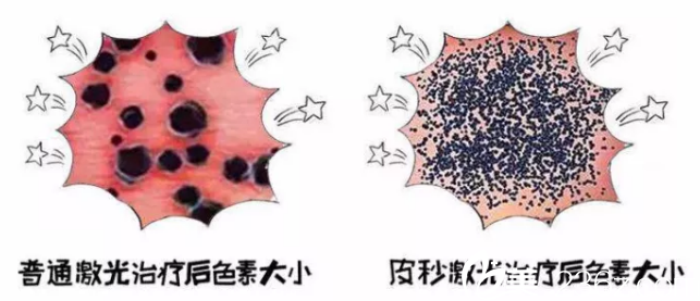 蜂巢皮秒和普通激光对比 蜂巢皮秒和普通激光对比