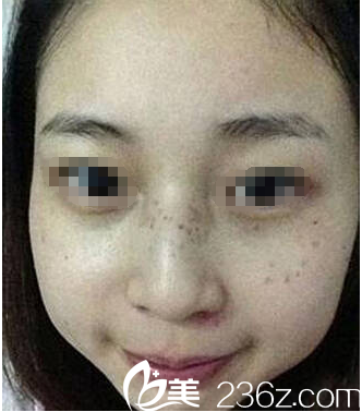 皮秒祛斑术后次效果 皮秒祛斑术后次效果