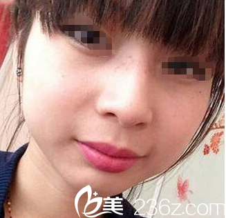 第二次皮秒激光祛斑术后恢复 第二次皮秒激光祛斑术后恢复