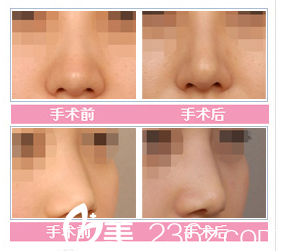 张家港康丽整形医院隆鼻对比案例 张家港康丽整形医院隆鼻对比案例