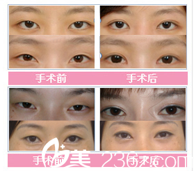 张家港康丽整形医院眼部整形对比案例 张家港康丽整形医院眼部整形对比案例