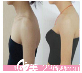 张家港康丽整形医院胸部整形对比案例 张家港康丽整形医院胸部整形对比案例