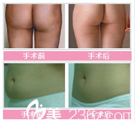 张家港康丽整形医院吸脂整形对比案例 张家港康丽整形医院吸脂整形对比案例