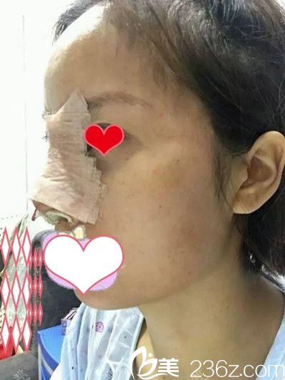 鼻综合手术后1天