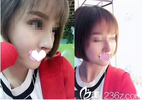 刘志强院长给我做鼻综合手术35天了