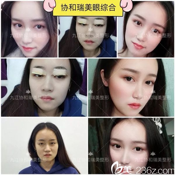 九江星瑞美双眼皮案例