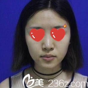 鼻整形术前照 鼻整形术前照