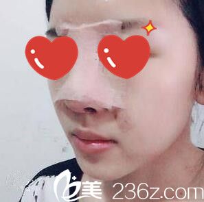 在美plus做鼻整形术后3天 在美plus做鼻整形术后3天