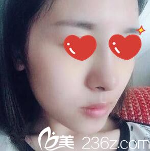 找崔尚默做鼻整形术后第八天 找崔尚默做鼻整形术后第八天