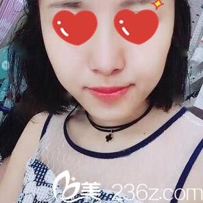 美plus崔尚默做的鼻整形术后1个月 美plus崔尚默做的鼻整形术后1个月