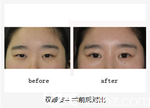 美艺双眼皮整形前后对比 美艺双眼皮整形前后对比
