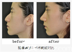 美艺鼻矫正前后对比 美艺鼻矫正前后对比