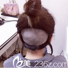 用的是我后脑勺的毛囊 用的是我后脑勺的毛囊