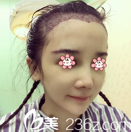 王昌林医生刚做完毛发移植 王昌林医生刚做完毛发移植