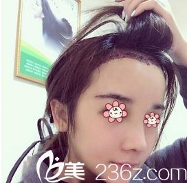 王昌林发际线调整术后第八天 王昌林发际线调整术后第八天