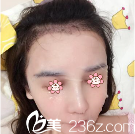 <!--<i data=20240703-sp></i>-->整形发际线调整术后一个月 <!--<i data=20240703-sp></i>-->整形发际线调整术后一个月