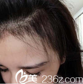 <!--<i data=20240703-sp></i>-->王昌林毛发移植术后两个月 <!--<i data=20240703-sp></i>-->王昌林毛发移植术后两个月