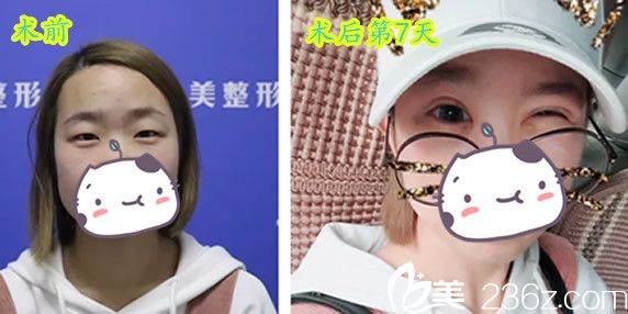 晶美朱博眼综合7天术前术后对比案例