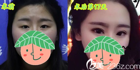 晶美石良兵院长眼综合17天术前术后对比案例效果展现