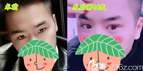 石良兵院长各割双眼皮术前术后案例对比照片