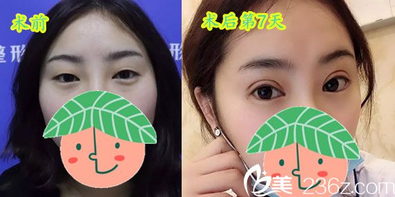 找石良兵主任做全切双眼皮7天恢复效果