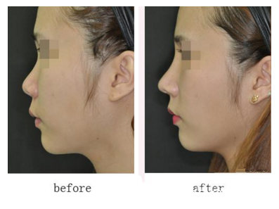 许政鼻部整形真人案例对比 许政鼻部整形真人案例对比