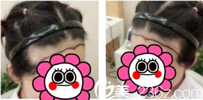 韩国江南艺丽人植发医院李承宰发际线种植真人案例术前照 韩国江南艺丽人植发医院李承宰发际线种植真人案例术前照