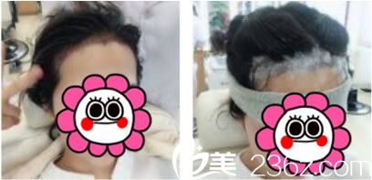 韩国江南艺丽人植发医院李承宰发际线种植术后第三天 韩国江南艺丽人植发医院李承宰发际线种植术后第三天