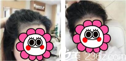 韩国江南艺丽人植发医院李承宰发际线种植术后第七天 韩国江南艺丽人植发医院李承宰发际线种植术后第七天