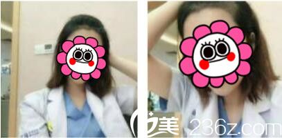 韩国江南艺丽人植发医院李承宰发际线种植术后三个月 韩国江南艺丽人植发医院李承宰发际线种植术后三个月