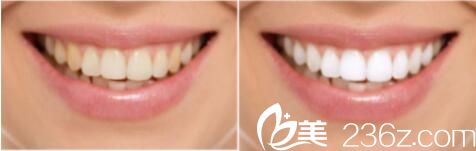 上海华美医疗美容医院齿科中心牙齿美白真人案例